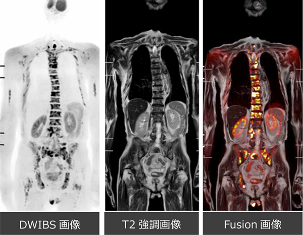 DWIBS(ドゥイブス)により画像診断